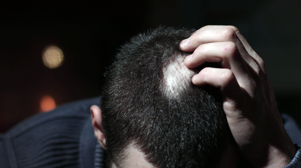 Alopecia areata: una patologia ancora alla ricerca di una vera e propria collocazione in ambito sanitario