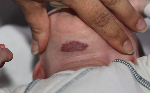 emangioma benigno