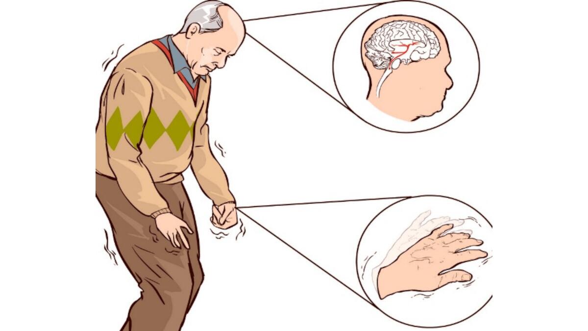Ricercatori catanesi premiati a Copenaghen per la ricerca medico-scientifica sulla malattia di Parkinson - 