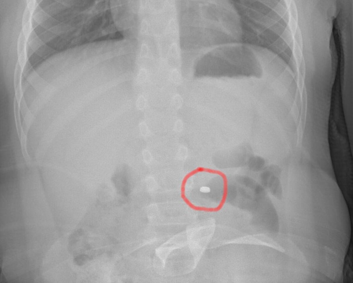 Bambino ingoia pila a bottone: intervento in sala operatoria all'Ospedale Cannizzaro - 