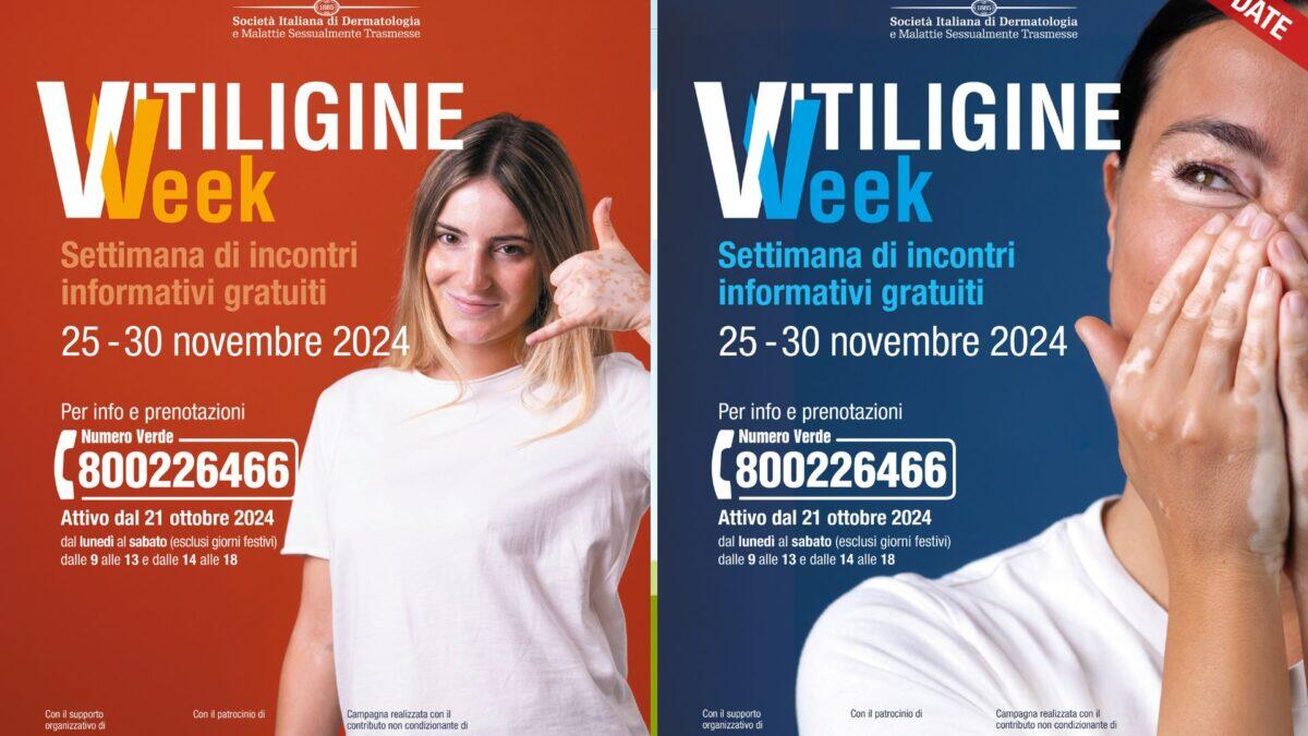 La ‘Vitiligine Week’ in Sicilia | Scopri perché questa malattia è molto più di una semplice condizione estetica! - 