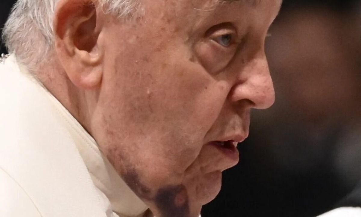 Il Papa si mostra con un vistoso ematoma sul collo: ecco il motivo