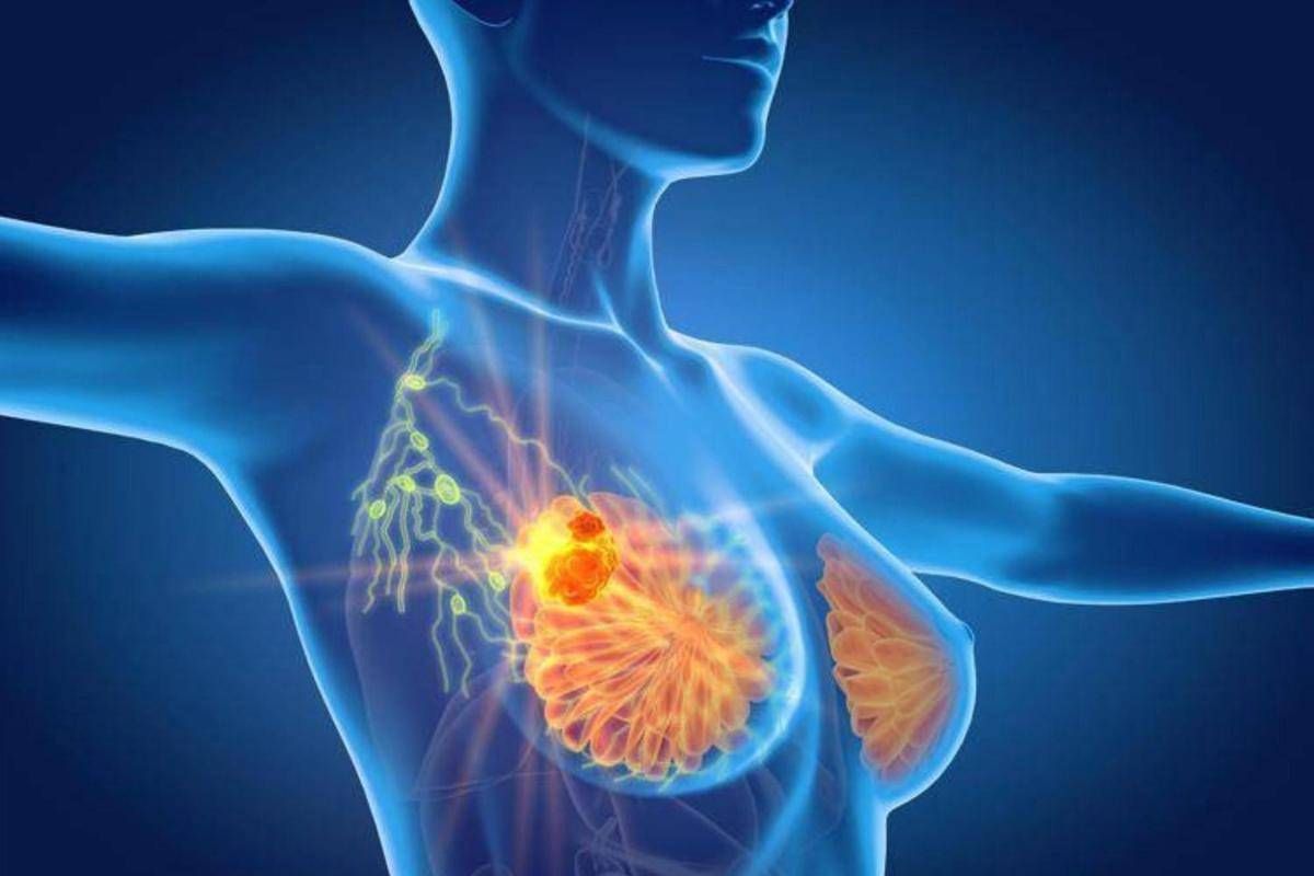 Tumore al seno triplo negativo, speranze da anticorpo farmaco-coniugato - 