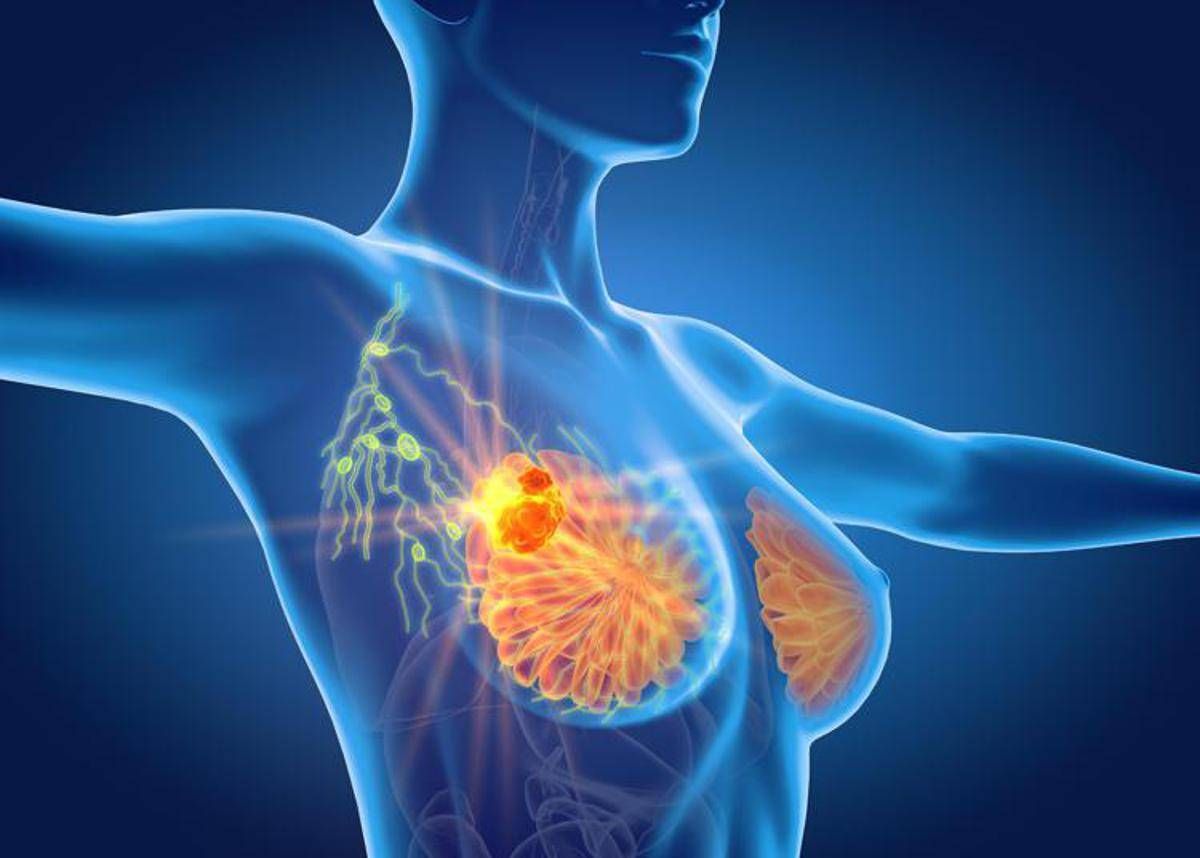 Per cancro seno la cura che arriva dal gelo, Ieo: "Verso un futuro no bisturi" - 