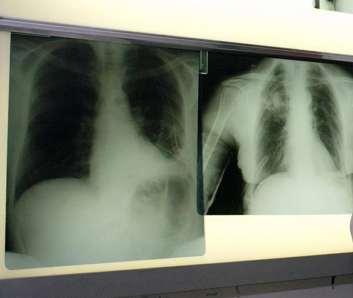 Cancro polmone a piccole cellule, ok Ue a tislelizumab - 