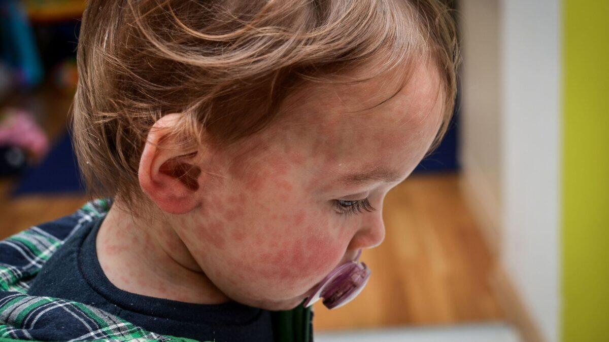 Bimba di 19 mesi in rianimazione per morbillo | La verità sui rischi del non vaccinare i bambini! - 