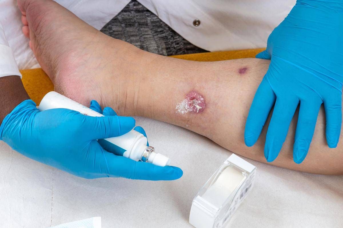 Idrosadenite suppurativa, quando fare la doccia o dormire diventano ostacoli - 
