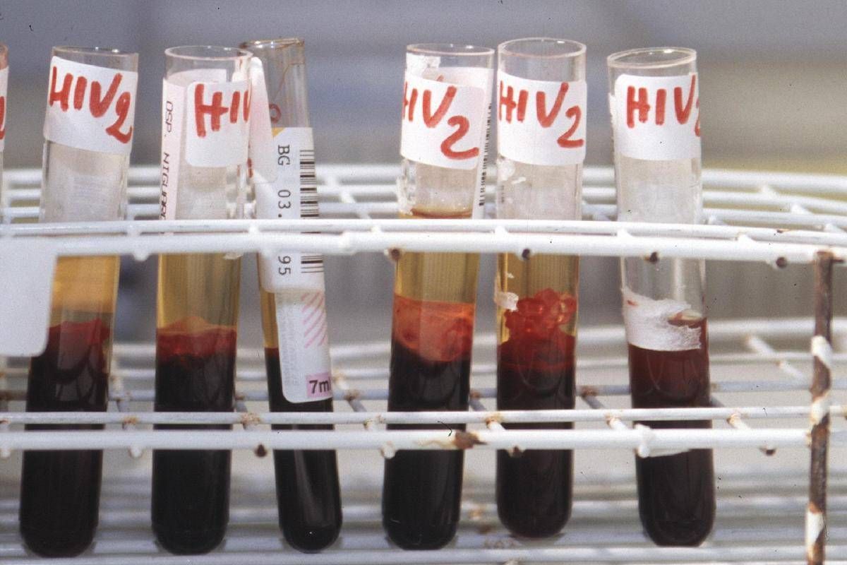 Aids, scoperti 'codici' del sistema immunitario per sospendere le cure - 