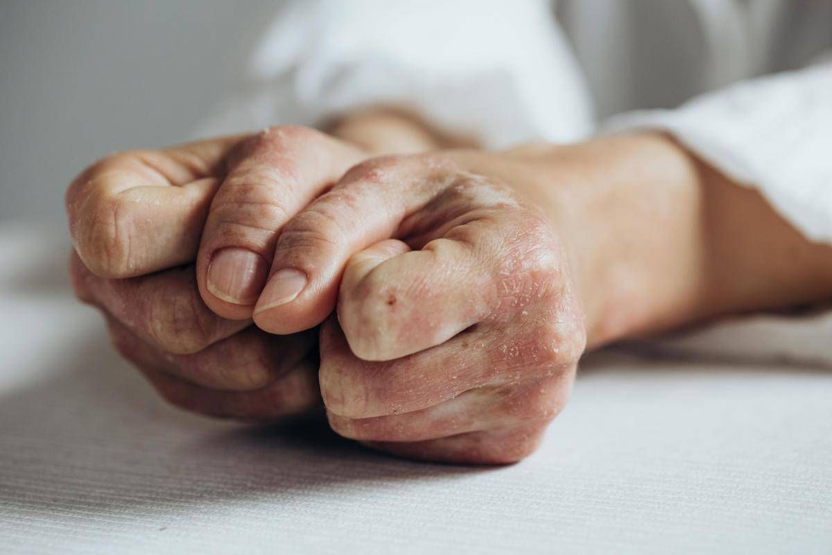 Lo studio, inibitore Il-23 riduce segni e sintomi artrite psoriasica attiva -