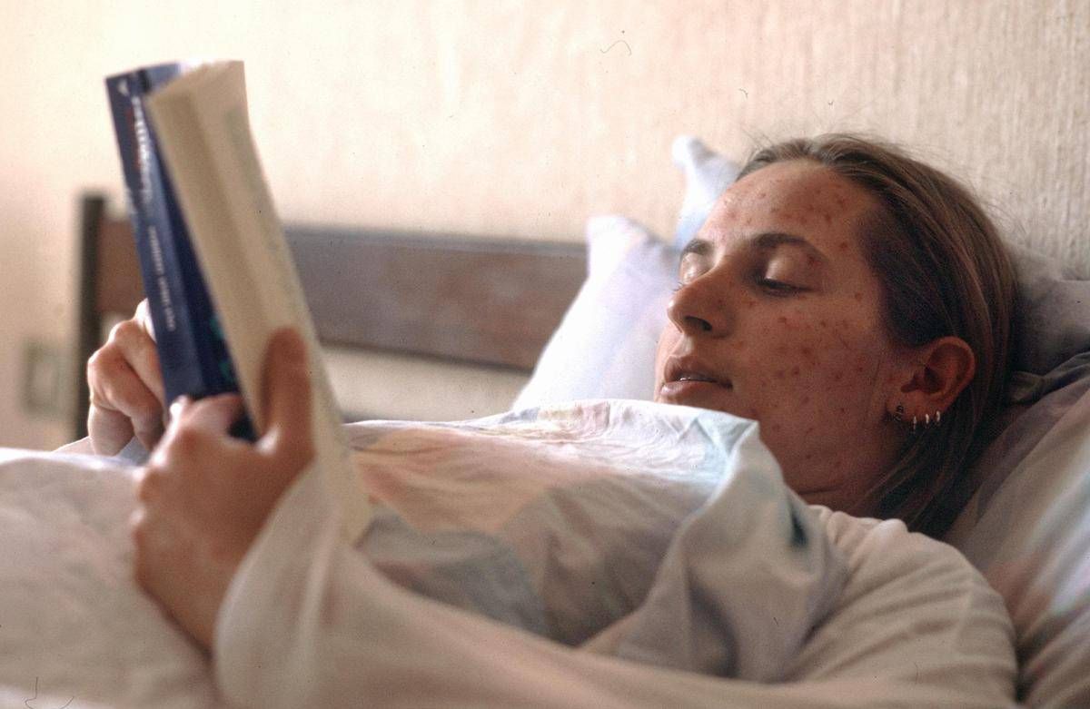Morbillo, casi raddoppiati da aprile a maggio: "Dato preoccupante" - 