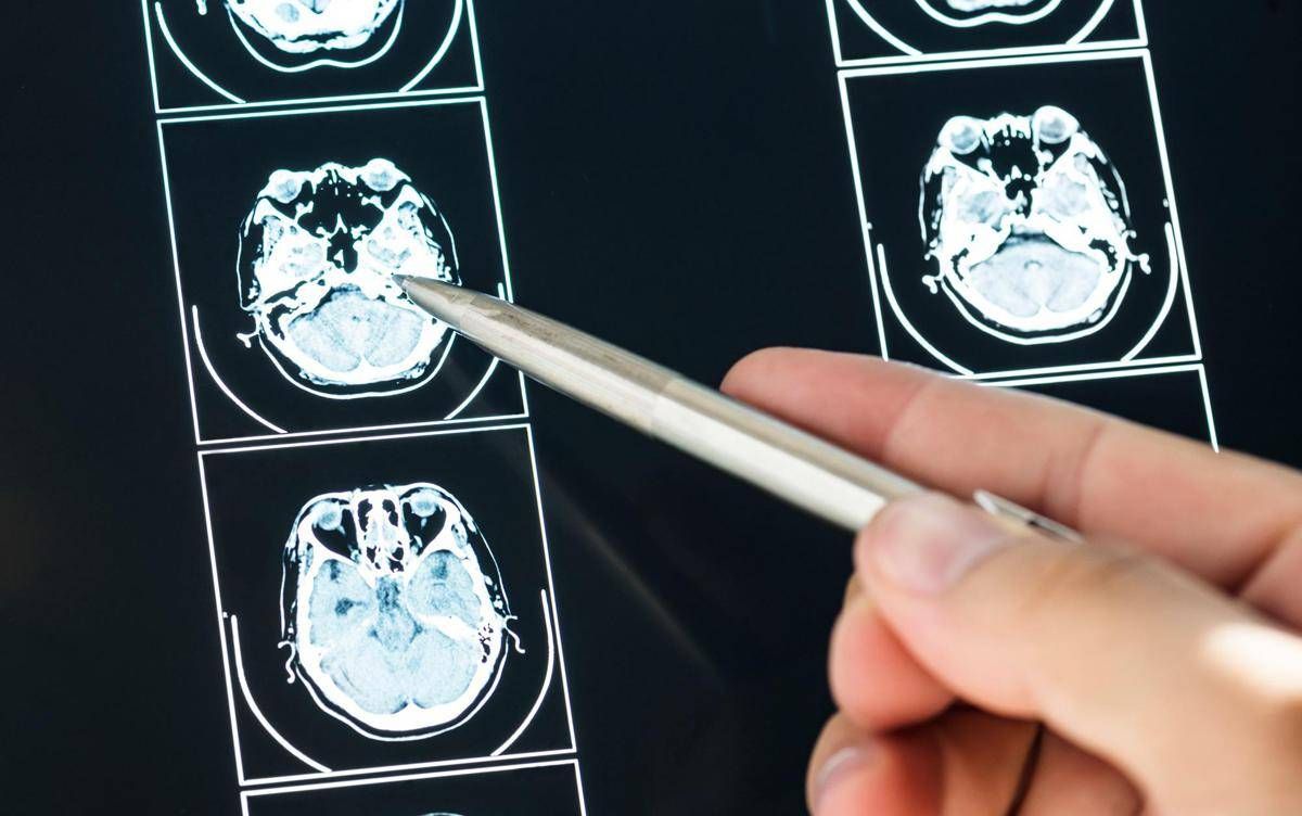 Intelligenza Artificiale può prevedere evoluzione Parkinson, lo studio italiano - 