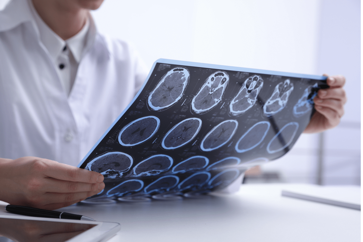 Sclerosi multipla e maternità, neurologa Marfia: "Personalizzare percorso" - 