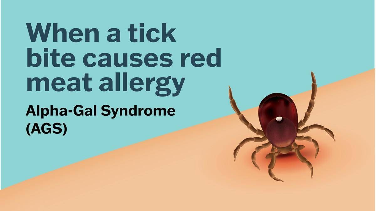 Se una zecca rende allergici a carne e latticini, cos'è la sindrome alfa-gal -