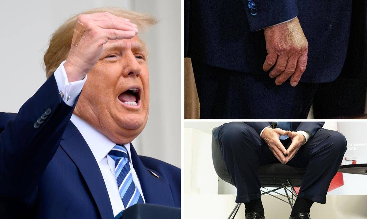 Trump e le gambe gonfie, cos'è l'insufficienza venosa cronica - 