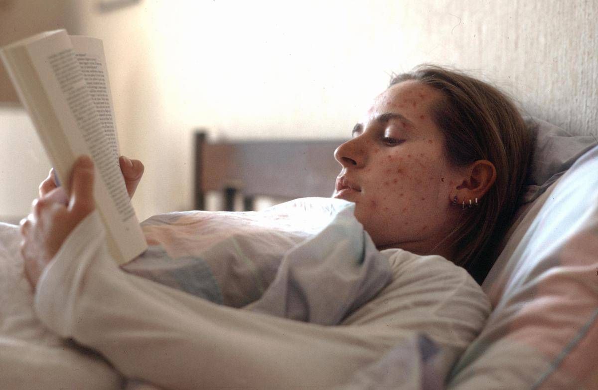 Morbillo, alcune persone più a rischio di altre: chi sono e perché -