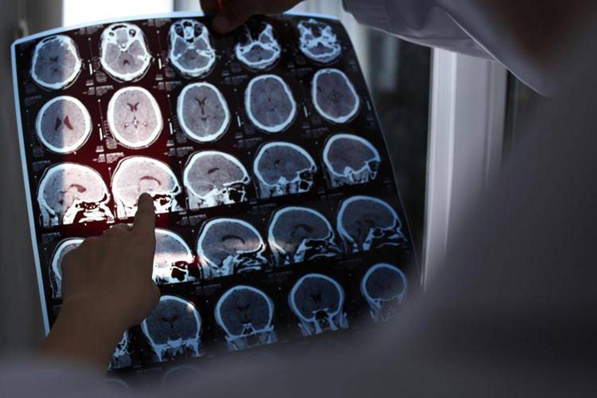 Rallentare l'Alzheimer con il litio, scoperta la 'scintilla' che innesca la patologia? - 