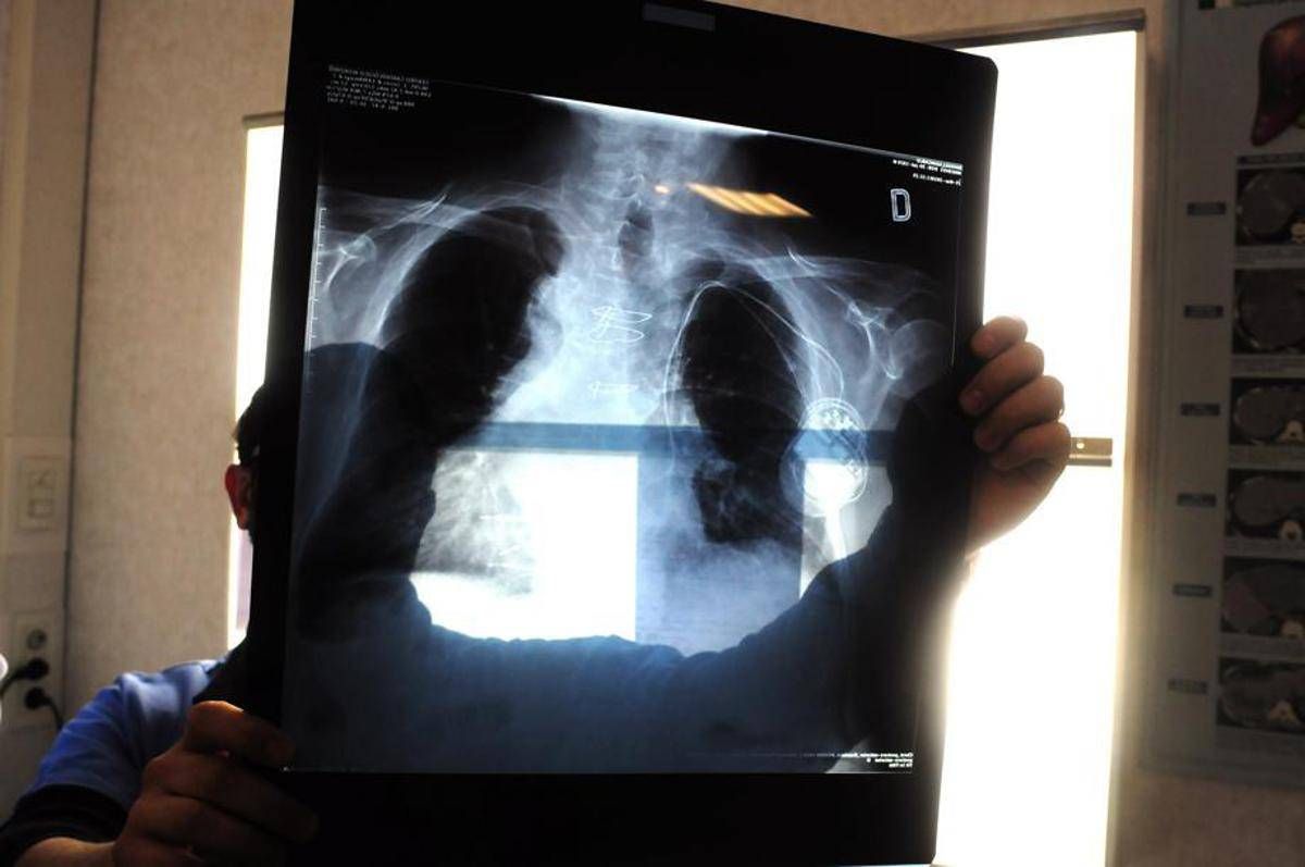 Tumore al polmone, con terapia mirata più chemio sopravvivenza globale di quasi 4 anni -