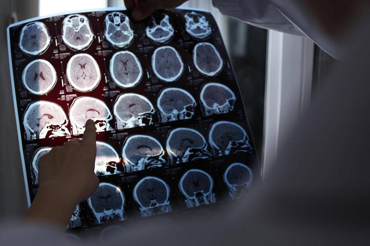 Nuove molecole e bersagli, così si evolve la terapia contro l'Alzheimer: il punto -