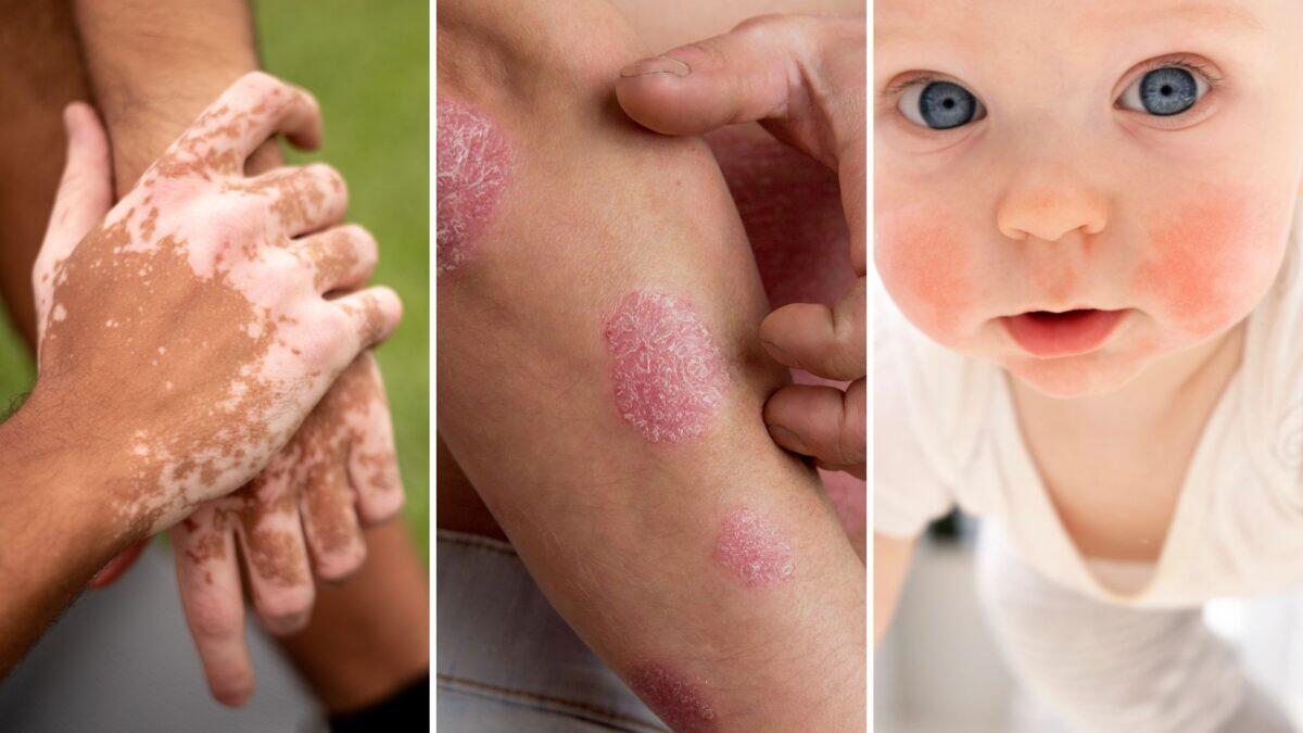 5,2 milioni di italiani affetti da psoriasi e dermatite | Perché il sistema sanitario continua a ignorarli? - 