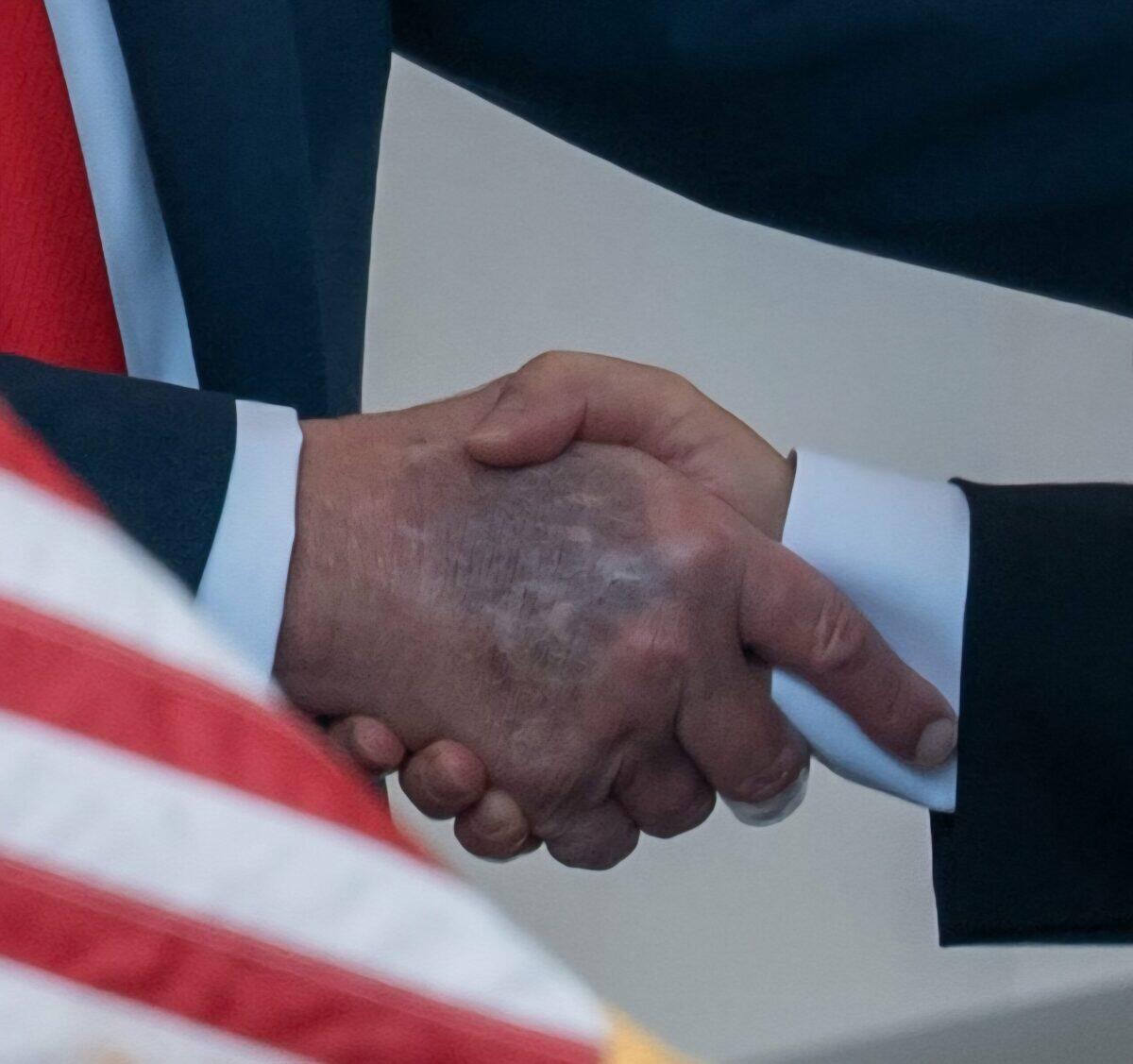 Trump e i lividi alla mano | Il mistero sulla sua salute svela un intrigo inaspettato! -