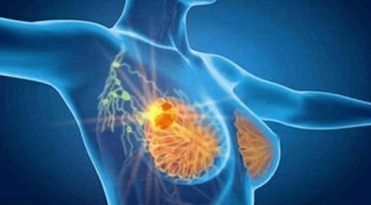 Cancro seno, con profilazione molecolare e terapie target migliori prospettive di cura - 