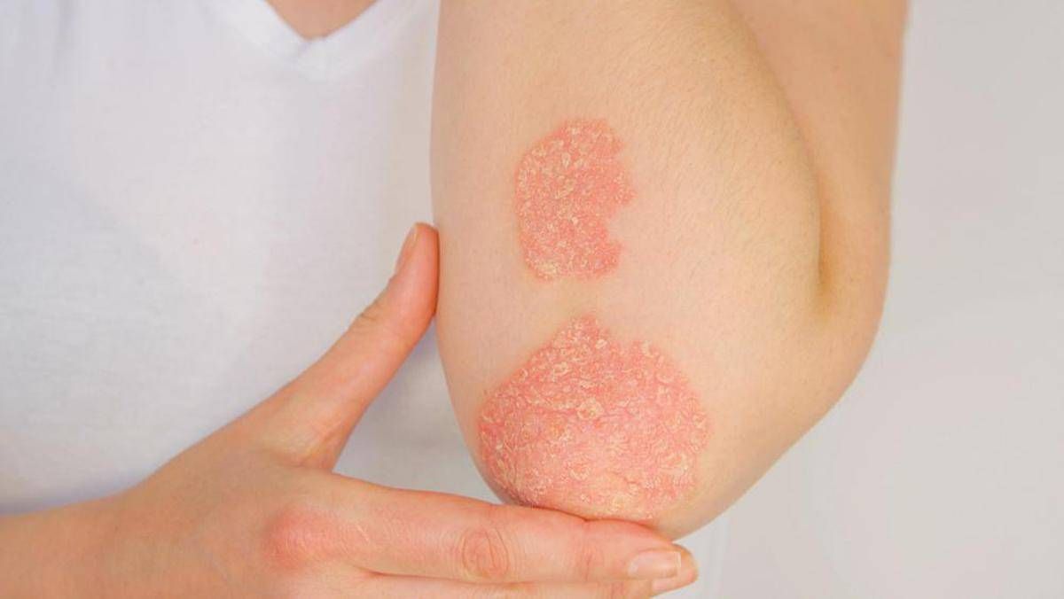 Giornata della psoriasi, Ucb conferma il suo impegno a fianco dei pazienti - 