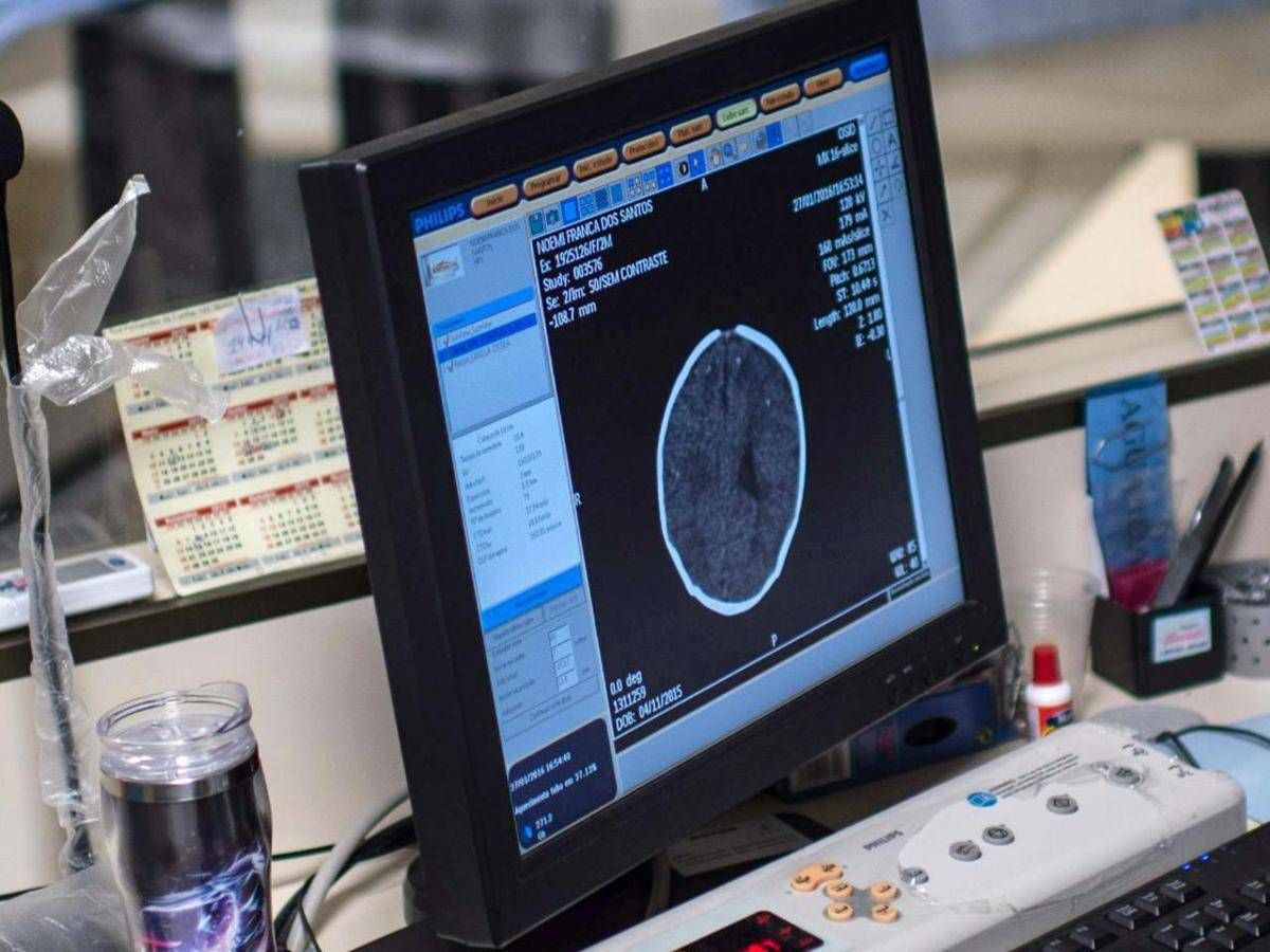 Salute, Padovani (Sin): "Longevità aumenta rischio Alzheimer, agire su prevenzione" - 