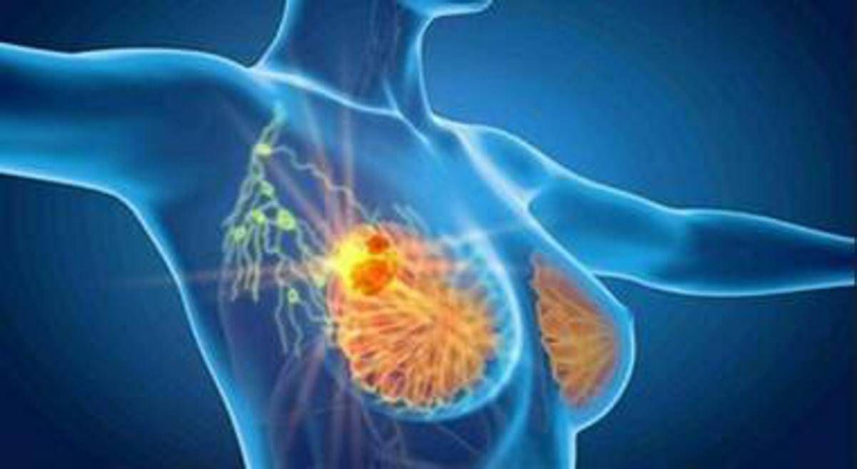 Cancro seno iniziale Her2+, con anticorpo farmaco-coniugato -53% recidiva -