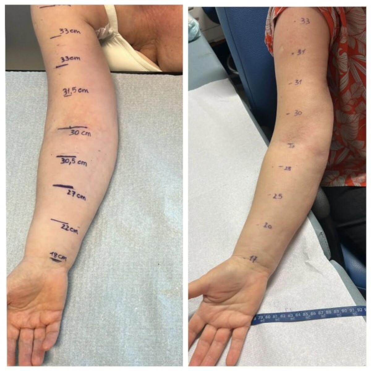 L'Ospedale Cannizzaro di Catania esegue il primo intervento Linfo-DIEP | Scopri perché questa innovazione rivoluzionaria sta cambiando le vite delle pazienti! - 