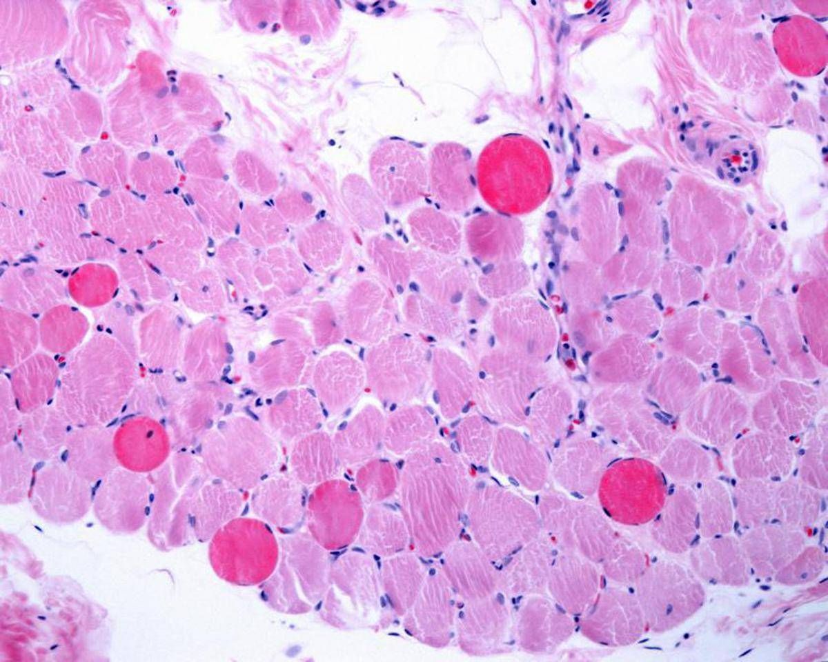 Malattie rare, risultati positivi a 5 anni per vamorolone in distrofia Duchenne - 