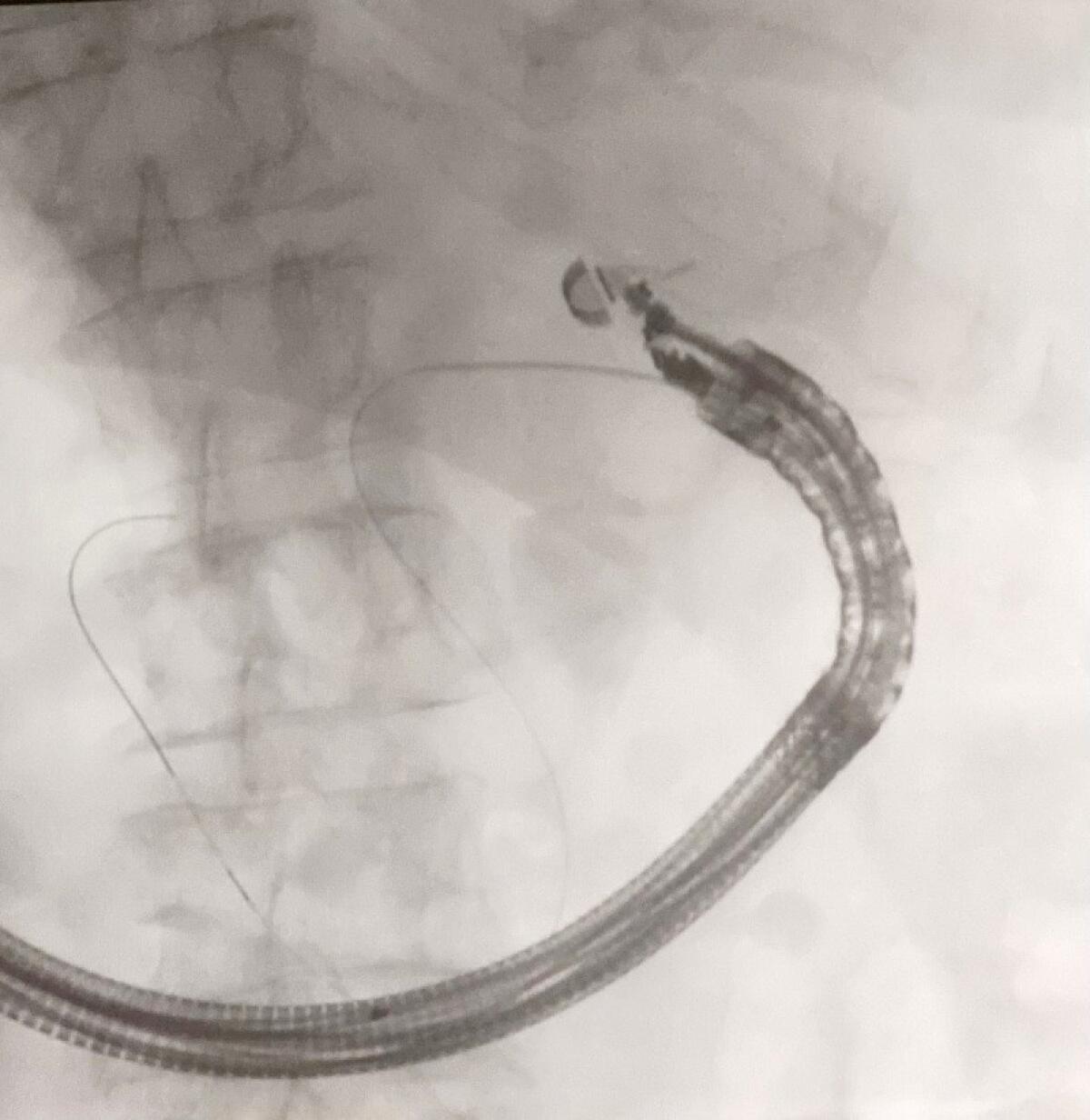 Trattamento innovativo al Ospedale Cannizzaro di Catania | Perché pochi sanno dell'intervento che sta rivoluzionando la gastroenterologia! - 