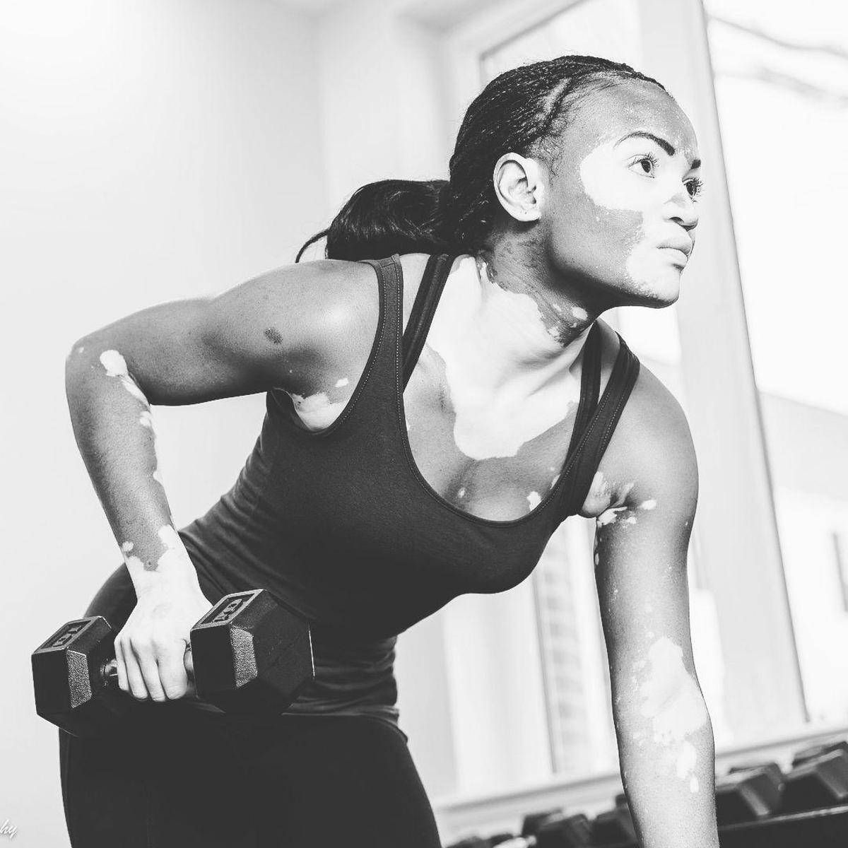 Vitiligine, "così la terapia della luce aiuta il farmaco" - 