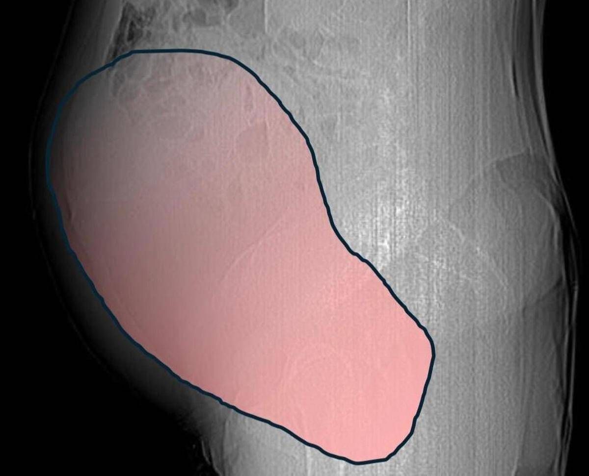 Intervento record al Sant'Anna di Torino, rimosso tumore ovarico di 6 kg - 
