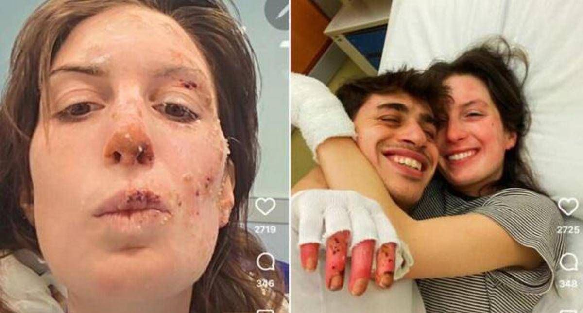 Crans-Montana, oggi dimessi due ragazzi. Eleonora Palmieri mostra le ustioni sui social - 