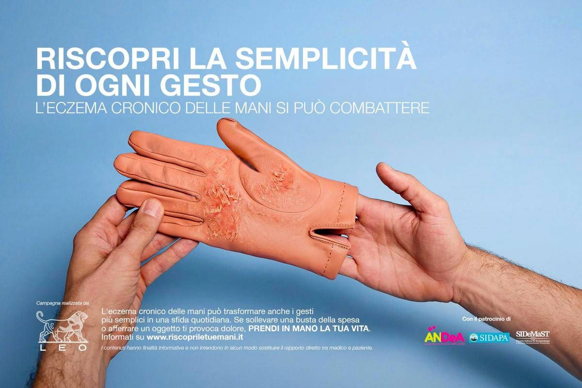 Mani che bruciano e fanno male, al via campagna su eczema cronico - 