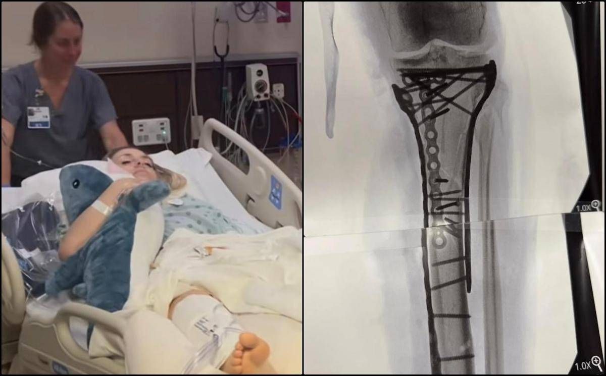 Milano Cortina, Vonn mostra la gamba dopo le operazioni: "Dolore difficile da gestire" - 