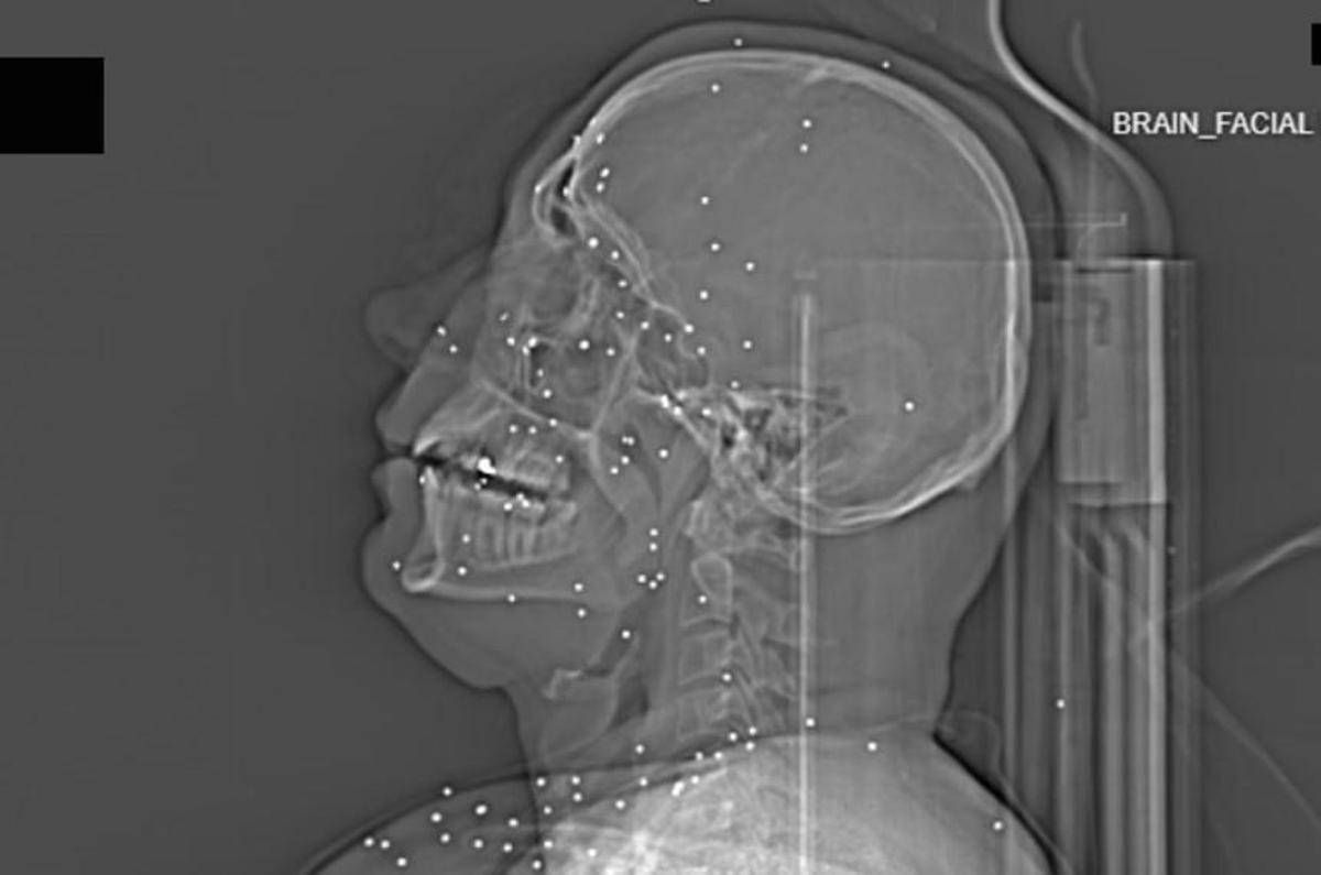 L'inchiesta horror sulle violenze iraniane: 'Manifestanti uccisi e colpiti nelle parti vitali' - 