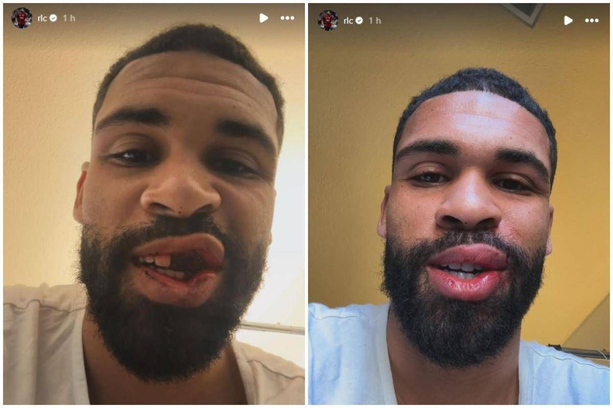 Loftus-Cheek, intervento riuscito alla mascella. E mostra foto dopo scontro in Milan-Parma - 