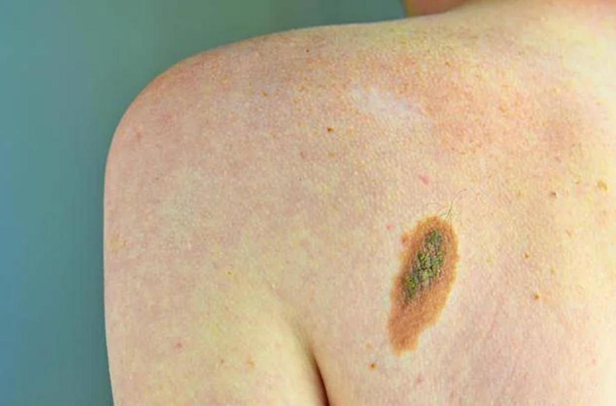 Imi: "Bene legge su prevenzione melanoma, educare i giovani su rischi" - 