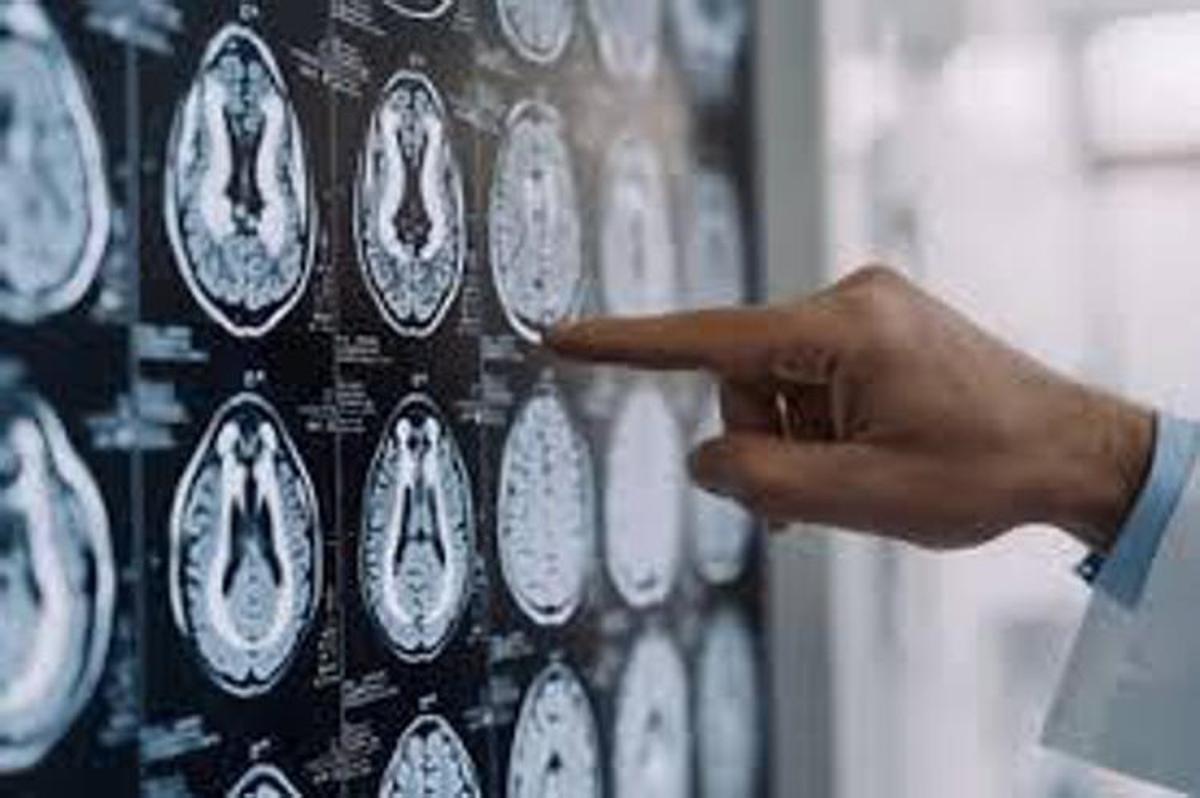 Malattia di Parkinson, ok in Europa a formulazione orale Ld/Cd a rilascio modificato - 