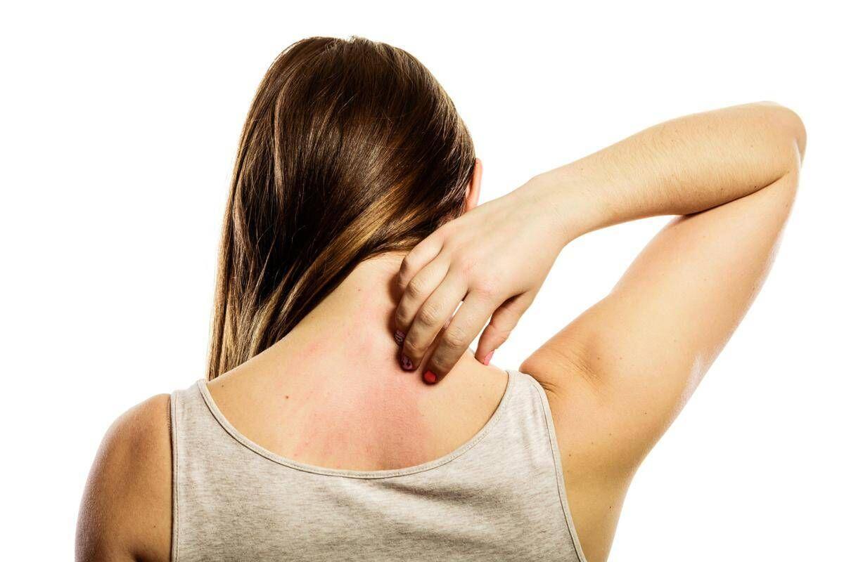 Linfoma cutaneo a cellule T, esperta: "Diagnosi difficile per sintomi dermatologici" - 