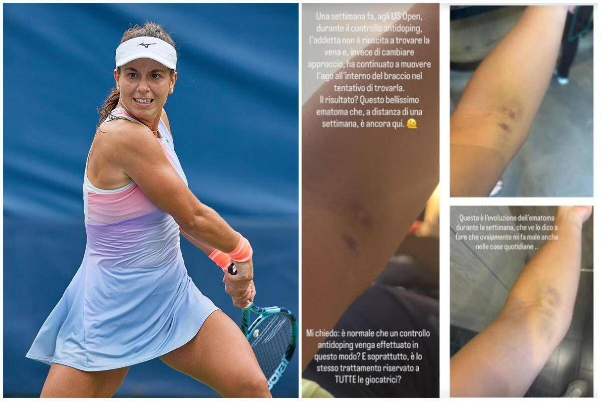 US Open, Stefanini e il livido sul braccio: "Colpa di un controllo antidoping..." - 