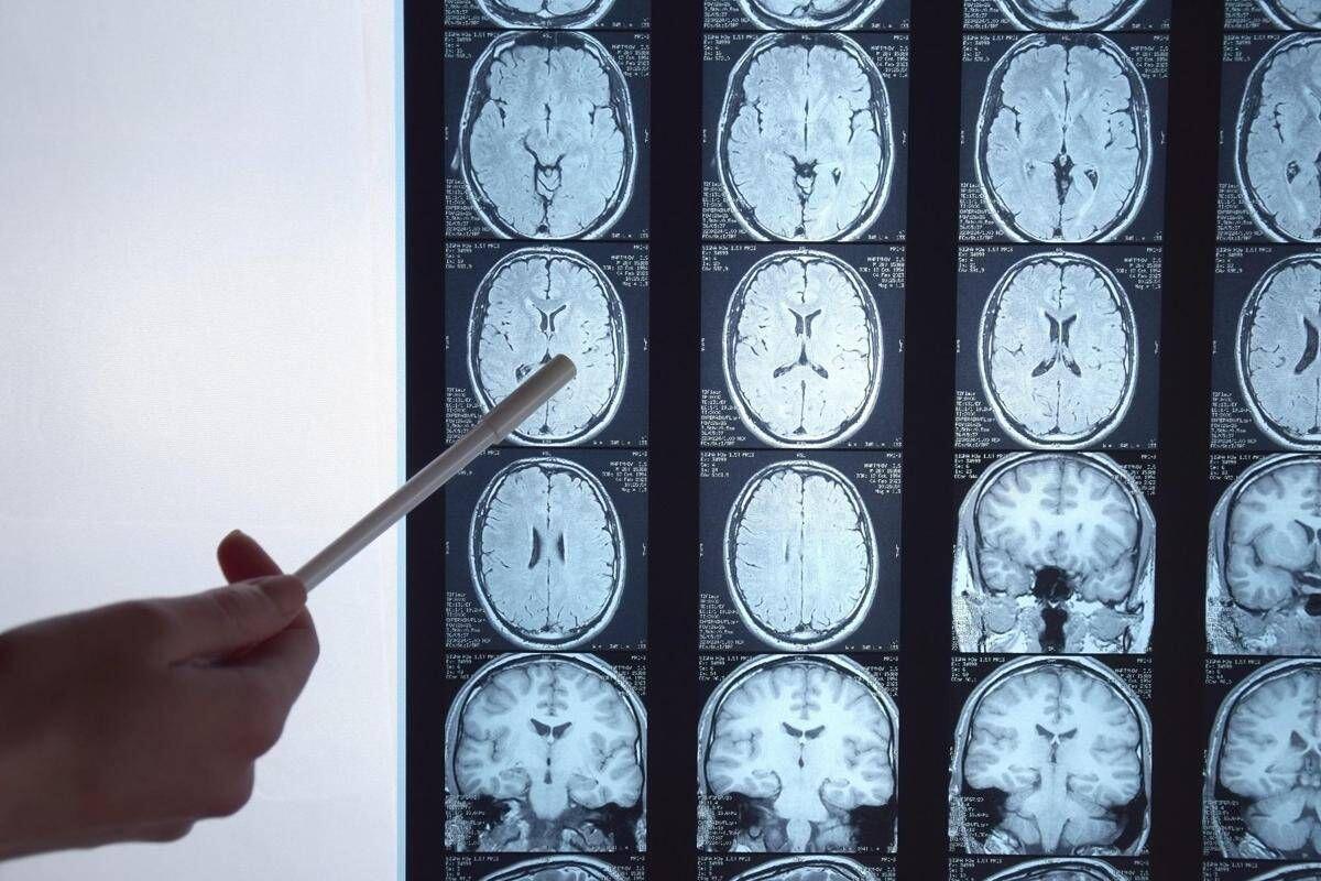 Di Battista e il tumore al cervello, in Italia circa 6mila diagnosi ogni anno: quali sono i sintomi 'spia' - 