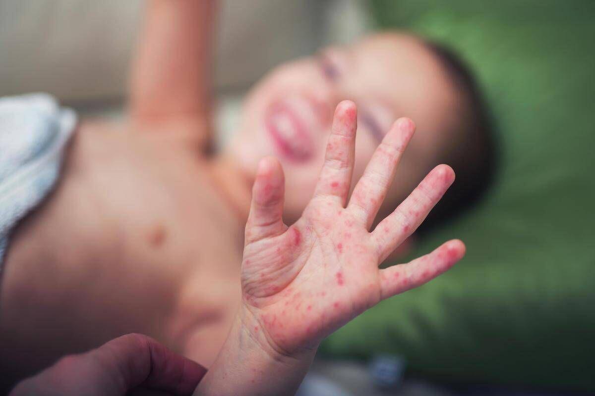 Morbillo, aumentano casi e ricoveri. Bassetti: "In Liguria focolaio senza precedenti, l'Italia rischia gravissima epidemia" - 