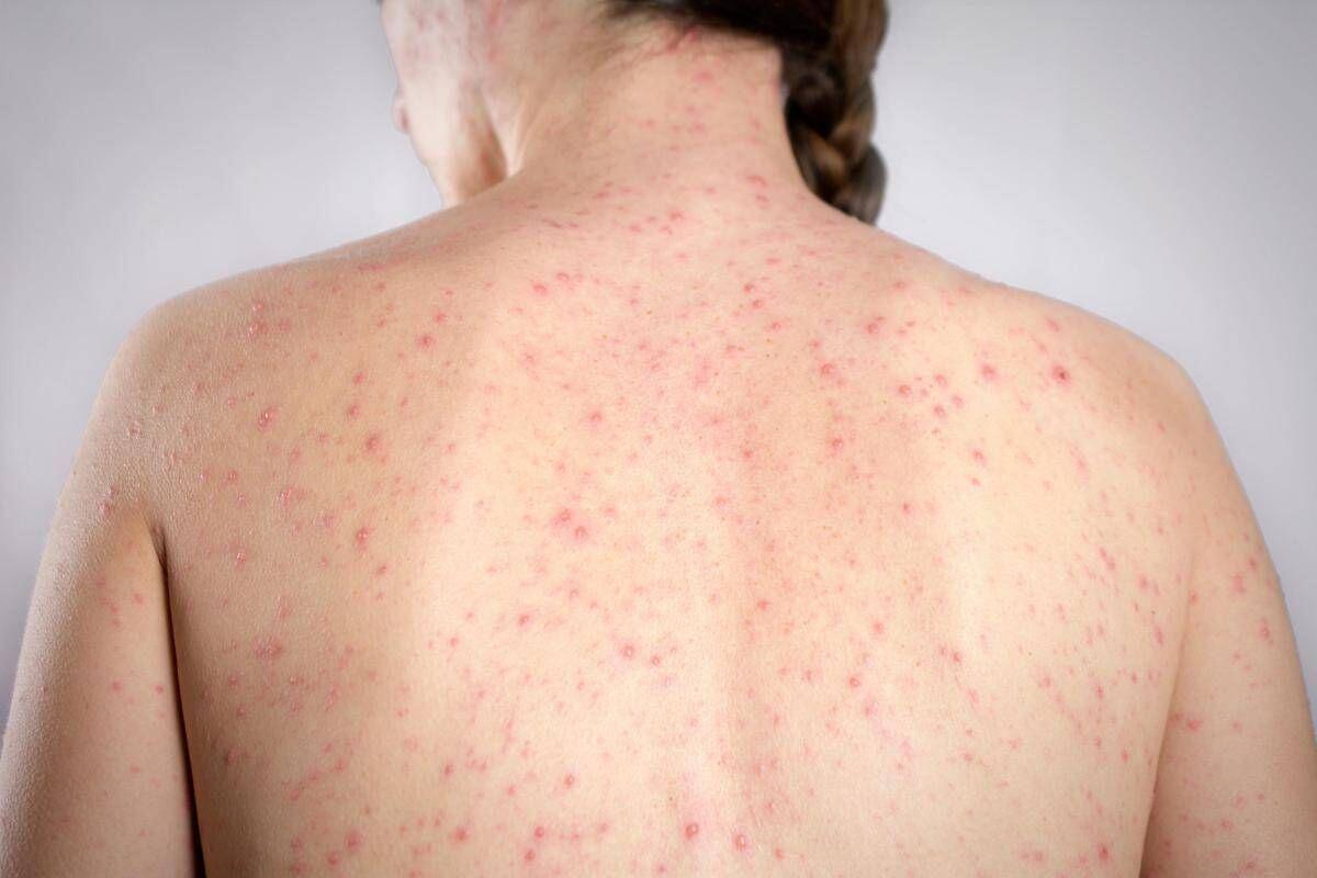 Morbillo, è allarme negli Usa. Italia prima per casi in Europa in in primi 6 mesi 2026 - 