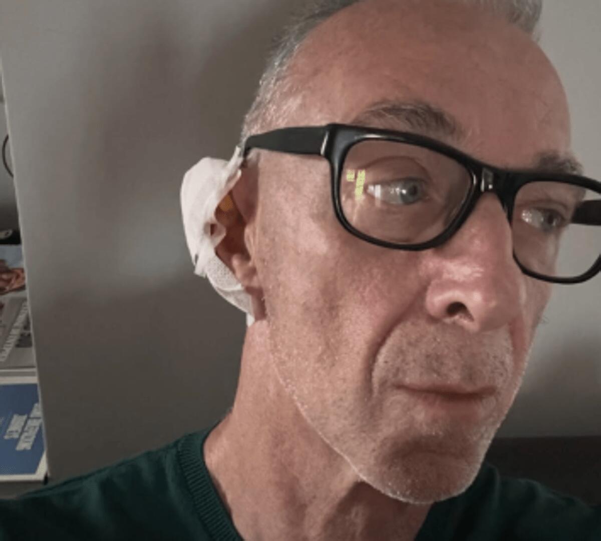 Linus ha una malattia della pelle: "Si chiama Epitelioma". Di cosa si tratta - 