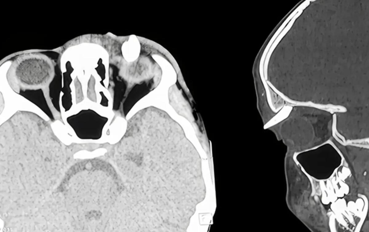 Ha un gonfiore sotto l'occhio, in ospedale scoprono che ha un dente nella palpebra: lo strano caso in India - 