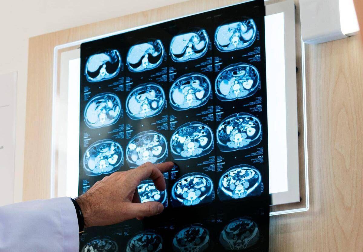 Nodulo polmonare: che cos’è, come si diagnostica e quando intervenire - 
