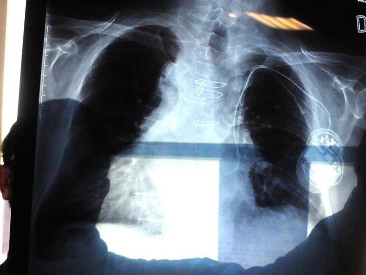 Cancro al polmone aggressivo, combinazione farmaci riduce del 58% rischio morte - 