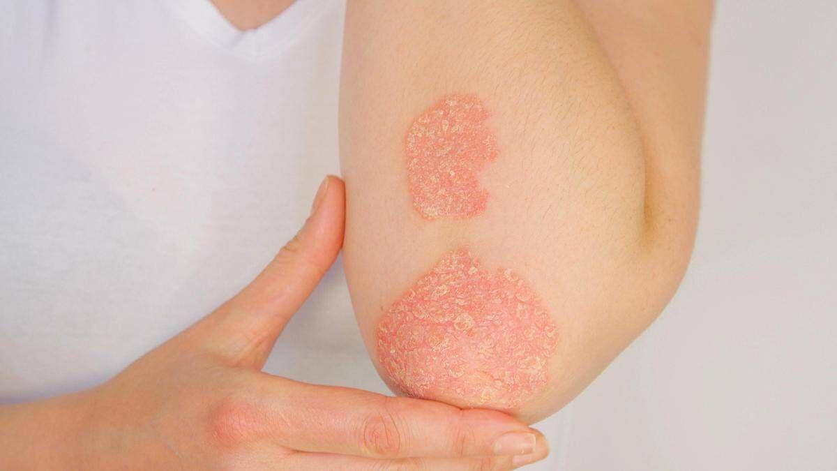 Giornata psoriasi, Ucb rinnova l'impegno contro lo stigma - 